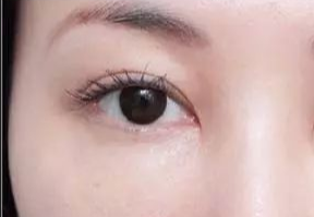 激光去眼袋什么人適合？