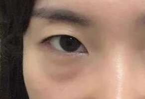 激光祛眼袋會(huì)疼嗎？