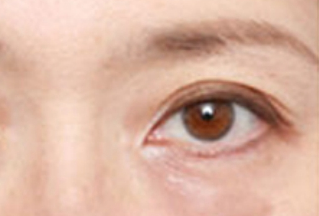 激光去眼袋幾天能恢復(fù)？激光去眼袋是怎樣的？