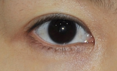 激光去眼袋前后明顯嗎？激光去眼袋安全嗎？