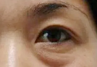 激光去眼袋會(huì)反彈嗎？