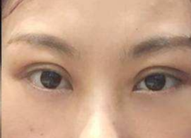 激光去眼袋可保持多久？