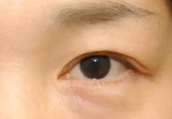 激光去眼袋術(shù)后會(huì)不會(huì)反彈？激光去眼袋術(shù)后注意事項(xiàng)？