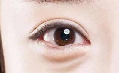 激光去眼袋是永久的嗎？