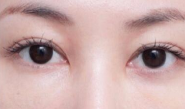 激光去眼袋安全嗎？