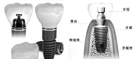 種植牙手術(shù)示意圖