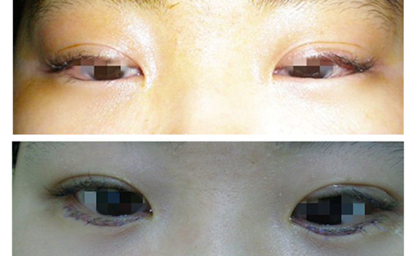 眼瞼內(nèi)翻什么意思？眼瞼內(nèi)翻怎么辦？