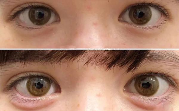 玻尿酸豐臥蠶效果是永久的嗎?術后有什么風險?