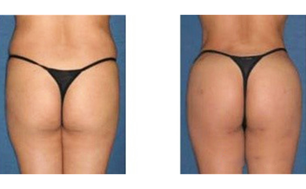 自體脂肪豐臀安全不安全?效果怎樣?