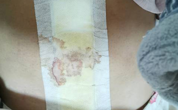 自體脂肪豐臀有副作用嗎?有什么風(fēng)險?