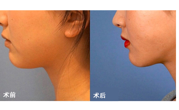 面部吸脂后皮膚會(huì)不會(huì)松弛？