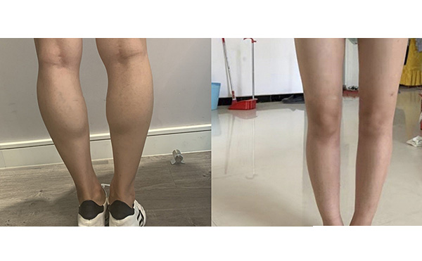 瘦腿針和吸脂哪個好？