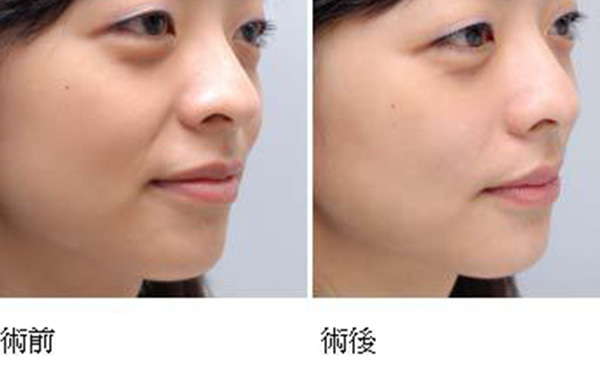 玻尿酸去法令紋需要多久能恢復(fù)？