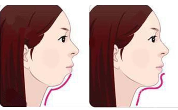 注射墊下巴的方式好嗎？