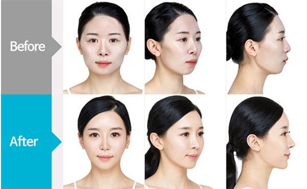 改臉型手術(shù)哪家好？