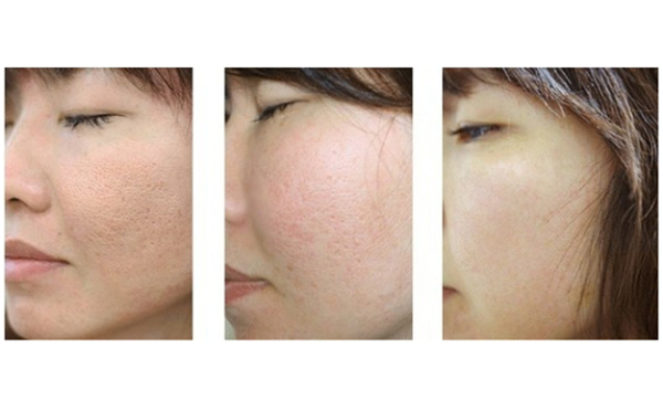 毛孔粗大需要做幾次彩光嫩膚？