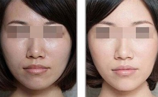 美白針的效果怎么樣？