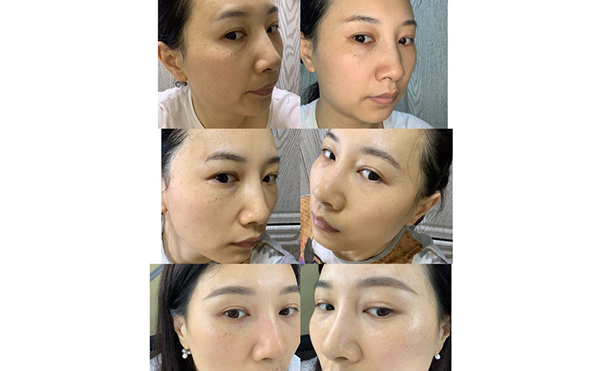 激光祛斑安全嗎？