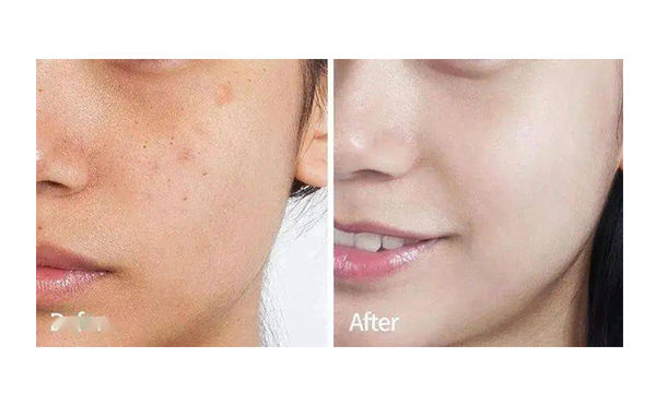 冰點(diǎn)嫩膚的效果怎么樣?有哪些優(yōu)點(diǎn)?