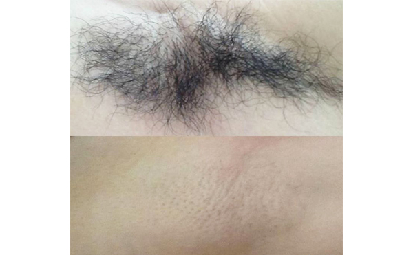 激光脫腋毛疼嗎？