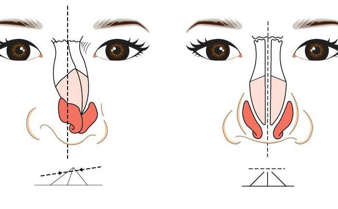 鼻子歪矯正大約多少錢？鼻子歪矯正恢復期多久？