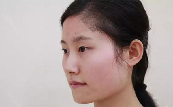 下頜角切除后還會(huì)再長(zhǎng)嗎？