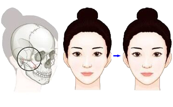 顴骨降低整形手術(shù)是怎么操作的？有什么特點？