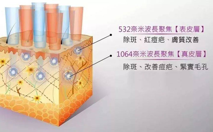 皮秒祛斑恢復(fù)期多久？