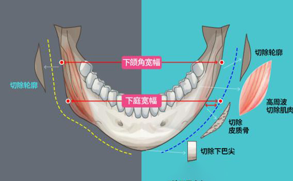 哪些因素會(huì)影響到下頜角手術(shù)的安全?