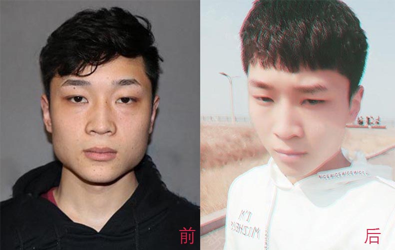 瘦臉針、面部吸脂如何選擇？