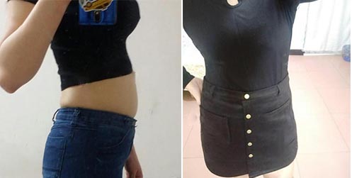 腹部吸脂前后對(duì)比
