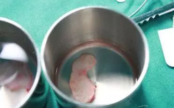 自體軟骨隆鼻是取自身體的那個(gè)部位？哪個(gè)部位的軟骨隆鼻效果更好