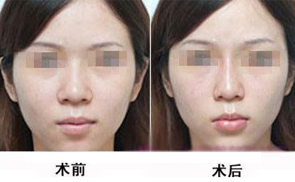 鼻頭縮小手術(shù)是怎么做的？術(shù)后應(yīng)該怎么護(hù)理