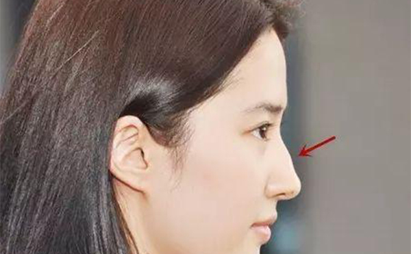 駝峰鼻要怎么改善？