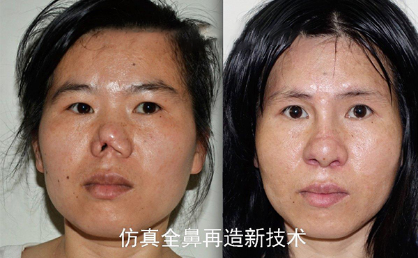 怎么做鼻再造手術(shù)?鼻再造的過(guò)程是怎樣的