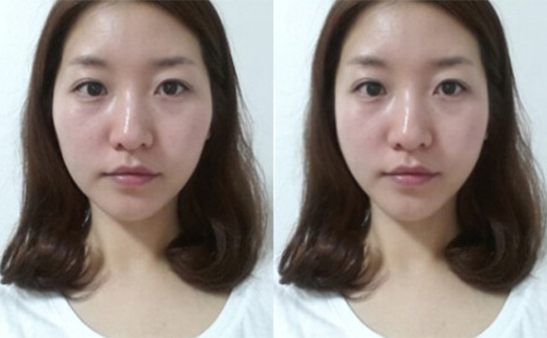 如何有效避免顴骨整形手術(shù)的風(fēng)險(xiǎn)?