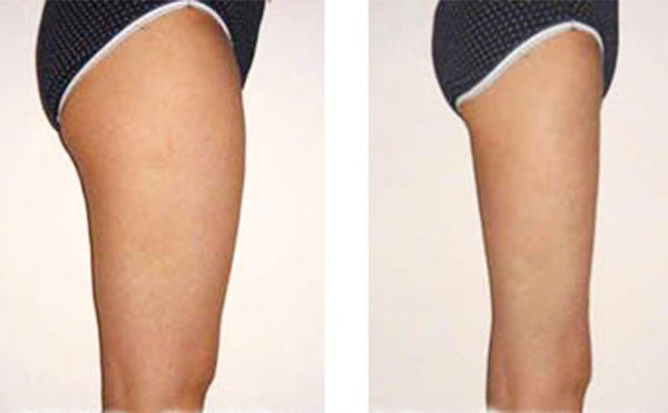 大腿吸脂會損壞肌肉嗎？