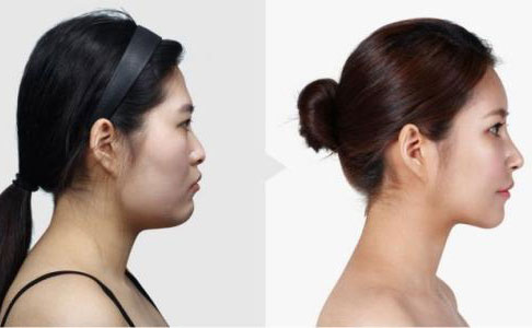 隆鼻手術(shù)多久恢復自然？