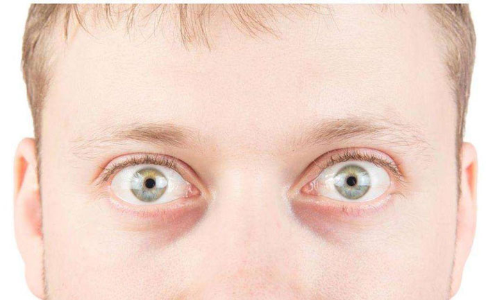 眼球突出是什么原因引起的？眼球突出如何矯正？