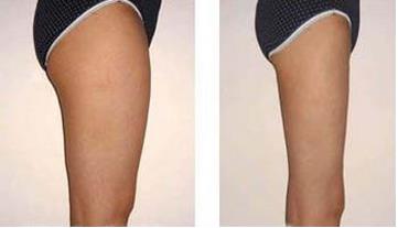 腿部吸脂手術(shù)有什么危害？