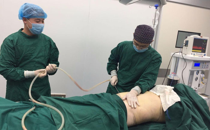 吸脂提臀線是怎么樣的？吸脂提臀多少錢？