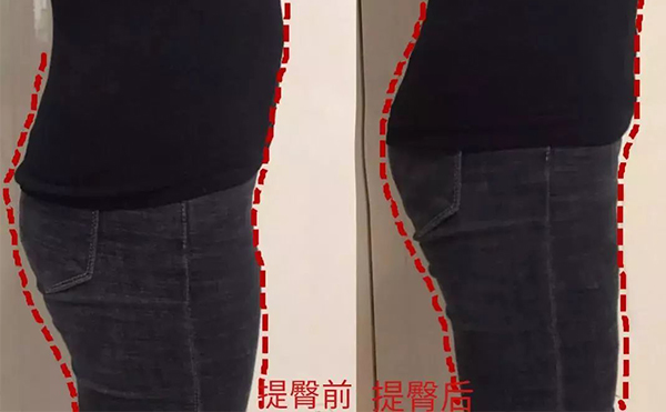什么是提臀術(shù)?提臀術(shù)有什么優(yōu)勢(shì)?