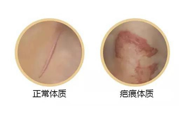 疤痕體質(zhì)割雙眼皮怎么樣?如何自測疤痕體質(zhì)?