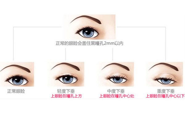上瞼下垂是什么原因造成的?上瞼下垂怎么改善?
