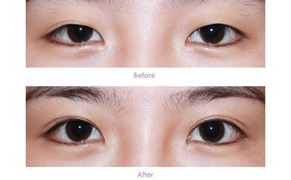 微創(chuàng)雙眼皮手術(shù)的優(yōu)點(diǎn)是什么?微創(chuàng)雙眼皮適合所有人嗎?