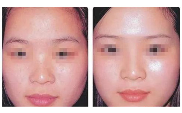 水光注射疼不疼？