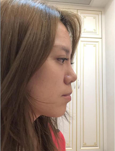 肋軟骨鼻綜合案例：術后效果