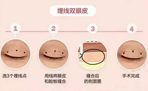 全切雙眼皮跟埋線(xiàn)的區(qū)別是什么？哪個(gè)好？