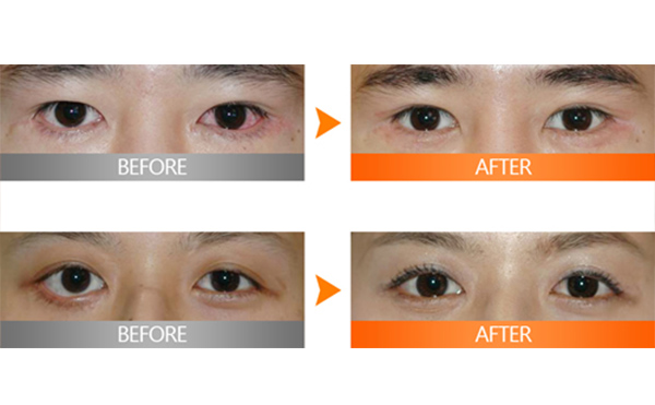 埋線雙眼皮失敗該如何修復(fù)？多久修復(fù)好？