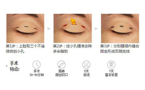 韓式三點(diǎn)雙眼皮的手術(shù)過(guò)程是什么?術(shù)后怎么避免疤痕增生?